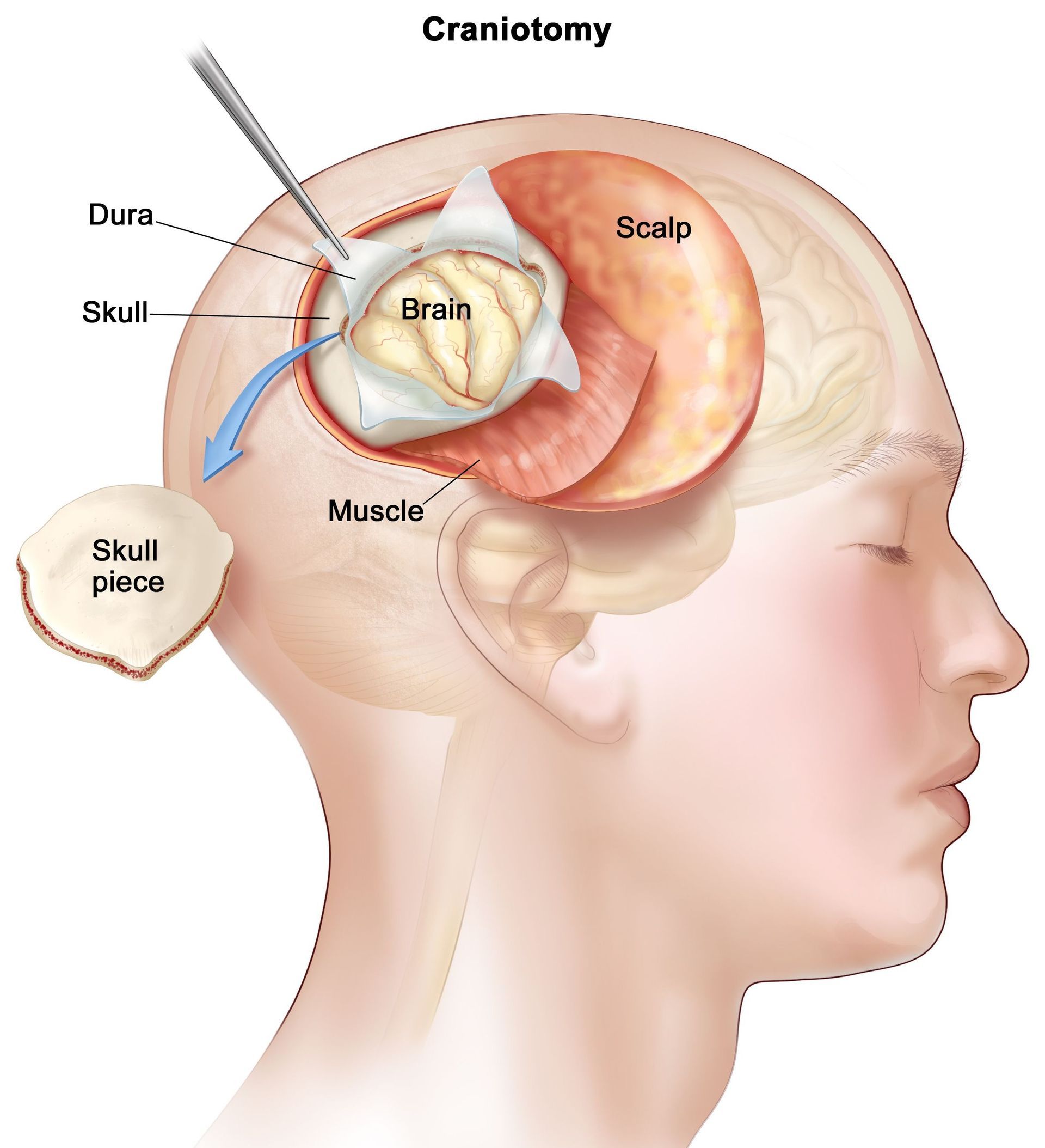 Pituitary
