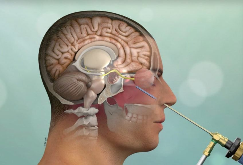 Pituitary