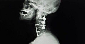 Posterior Cervical Fusion