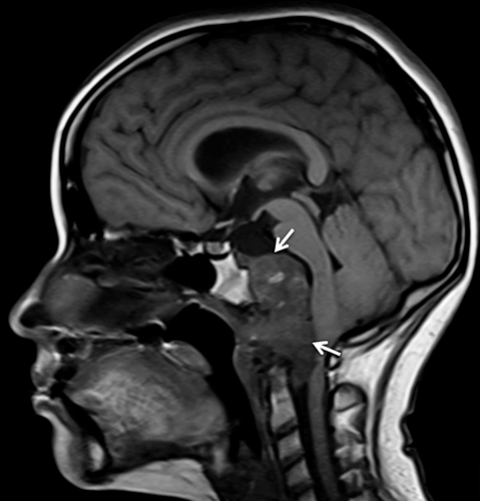 Chordoma