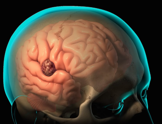 Chordoma