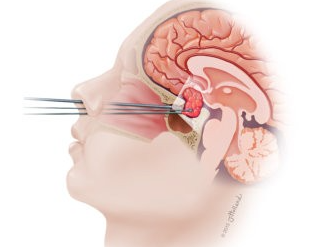 Pituitary