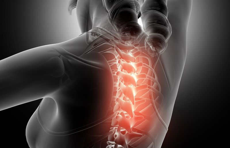 Cervical Myelopathy