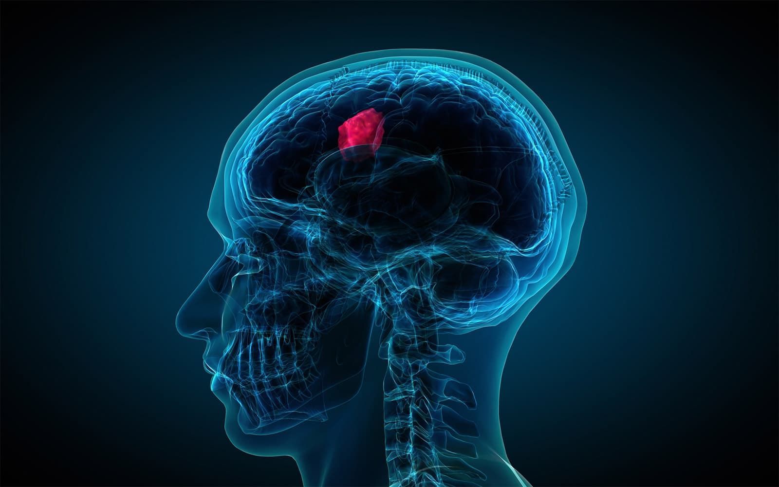 Meningioma