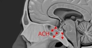 Cushing’s Disease
