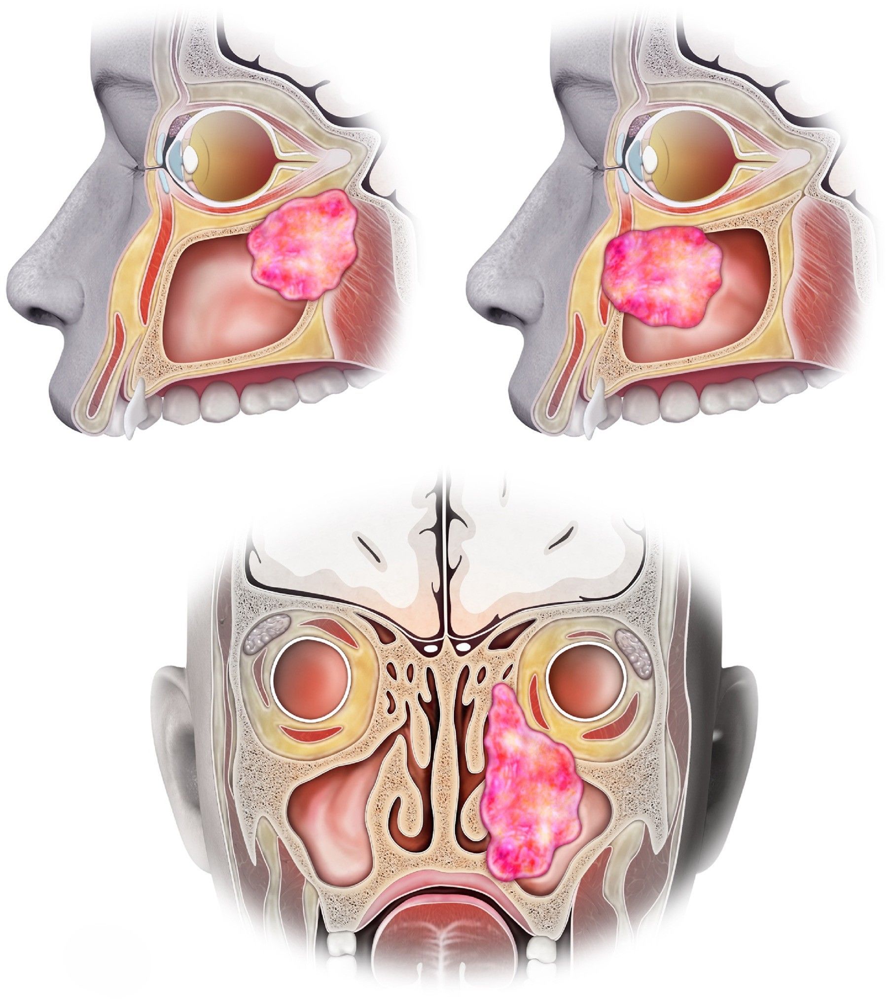 Sinonasal Carcinoma
