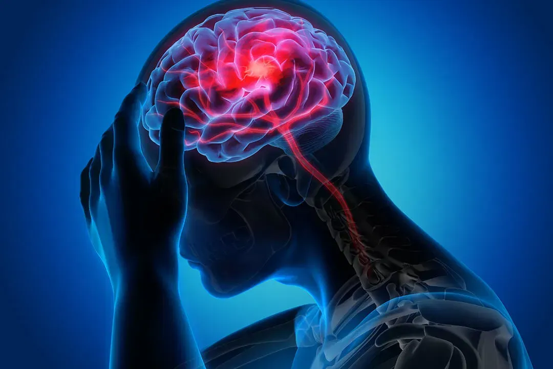 Epidermoid Cyst