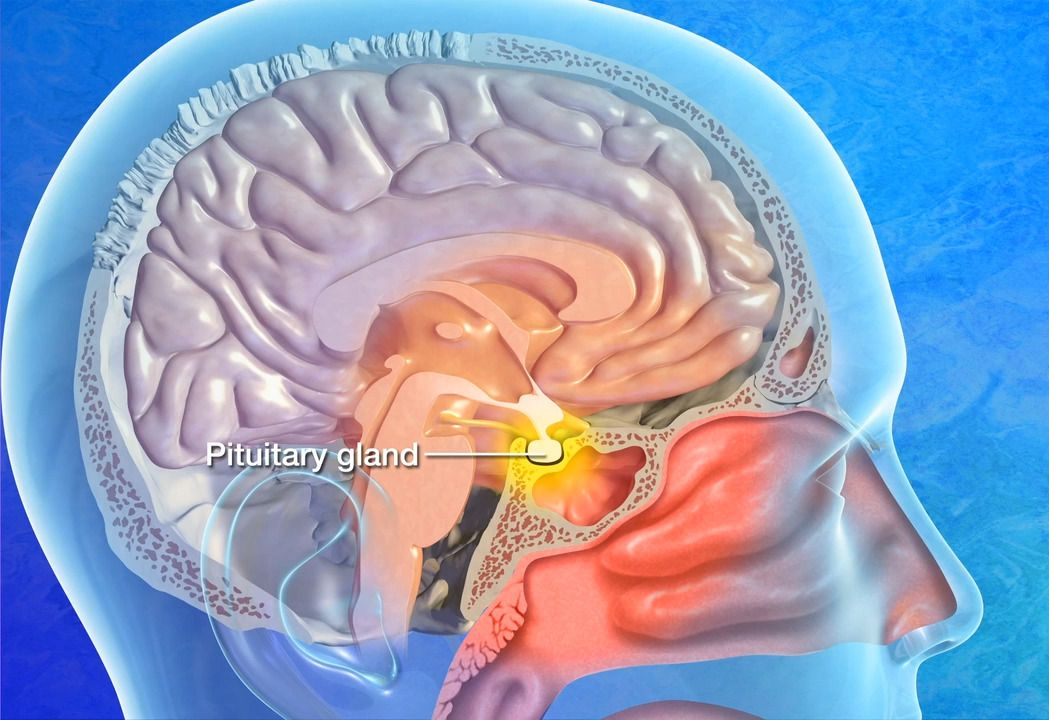 Acromegaly