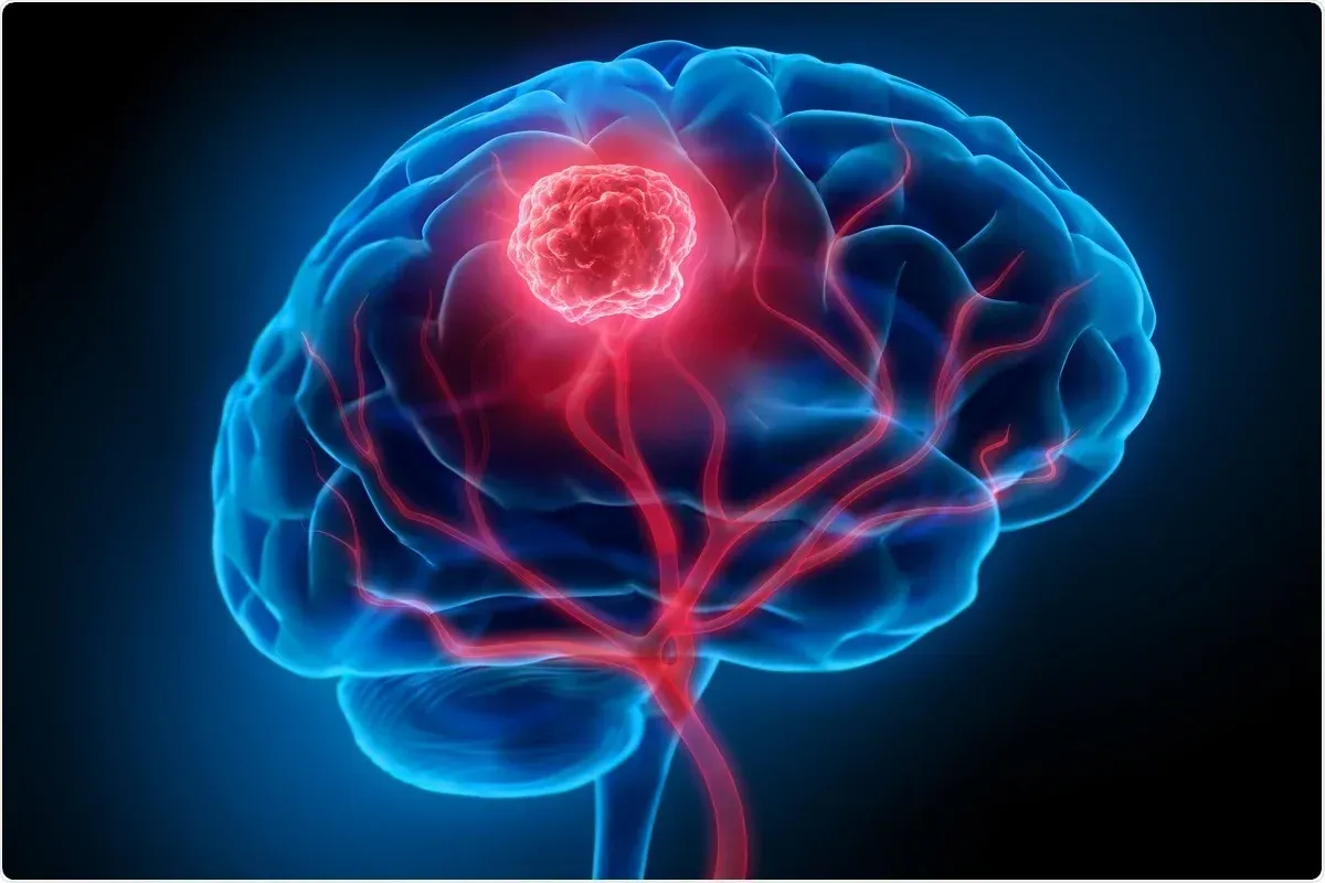 Glioma/Glioblastoma