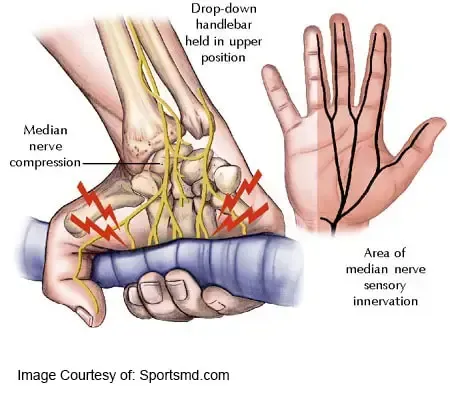Cyclist's Palsy and median nerve diagram