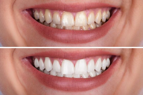 A comparison of teeth before and after whitening, showing a transition from yellowish to bright white. A comparison of teeth before and after whitening, showing a transition from yellowish to bright white.