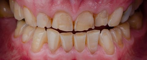 Close-up of teeth showing significant enamel wear, yellowing, and minor chipping on the edges of the upper incisors. Close-up of teeth showing significant enamel wear, yellowing, and minor chipping on the edges of the upper incisors.