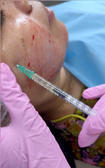 prp Aesthetic Clinic by Dr Ghizlaine Hayou