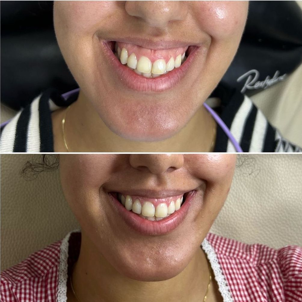 Sourire gingival Dr Ghizlaine HAYOU: Médecin Esthétique