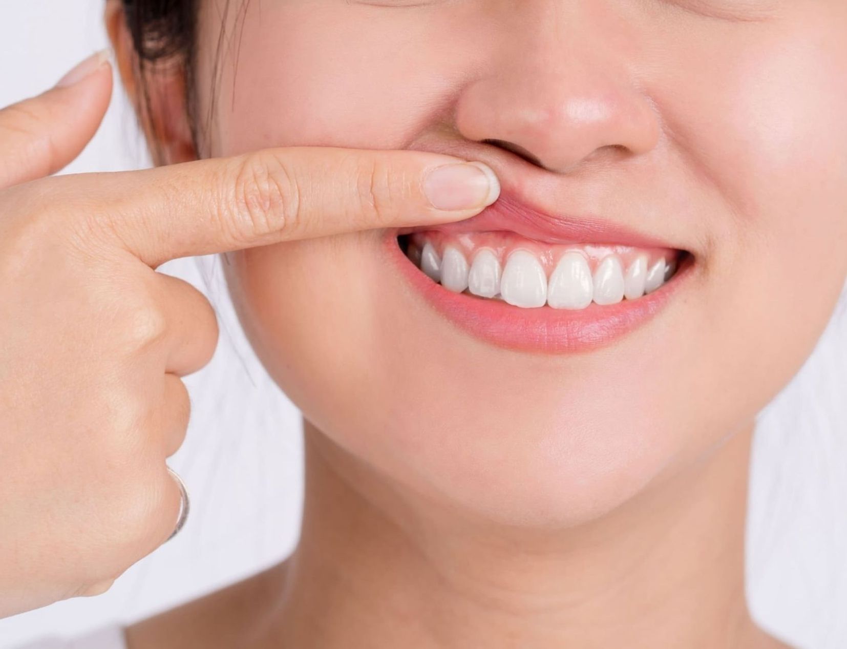 Traitement du sourire gingival by dr ghizlaine hayou