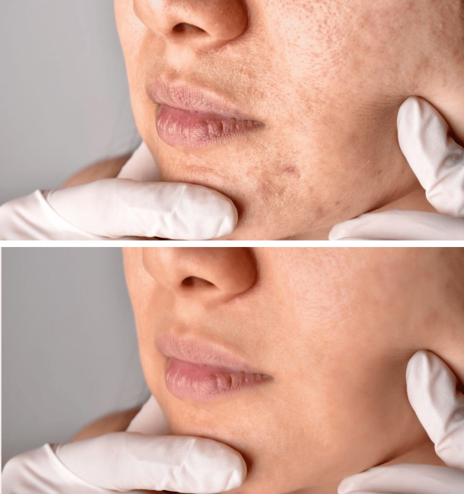 Traitement des taches Dr Ghizlaine HAYOU: Médecin Esthétique