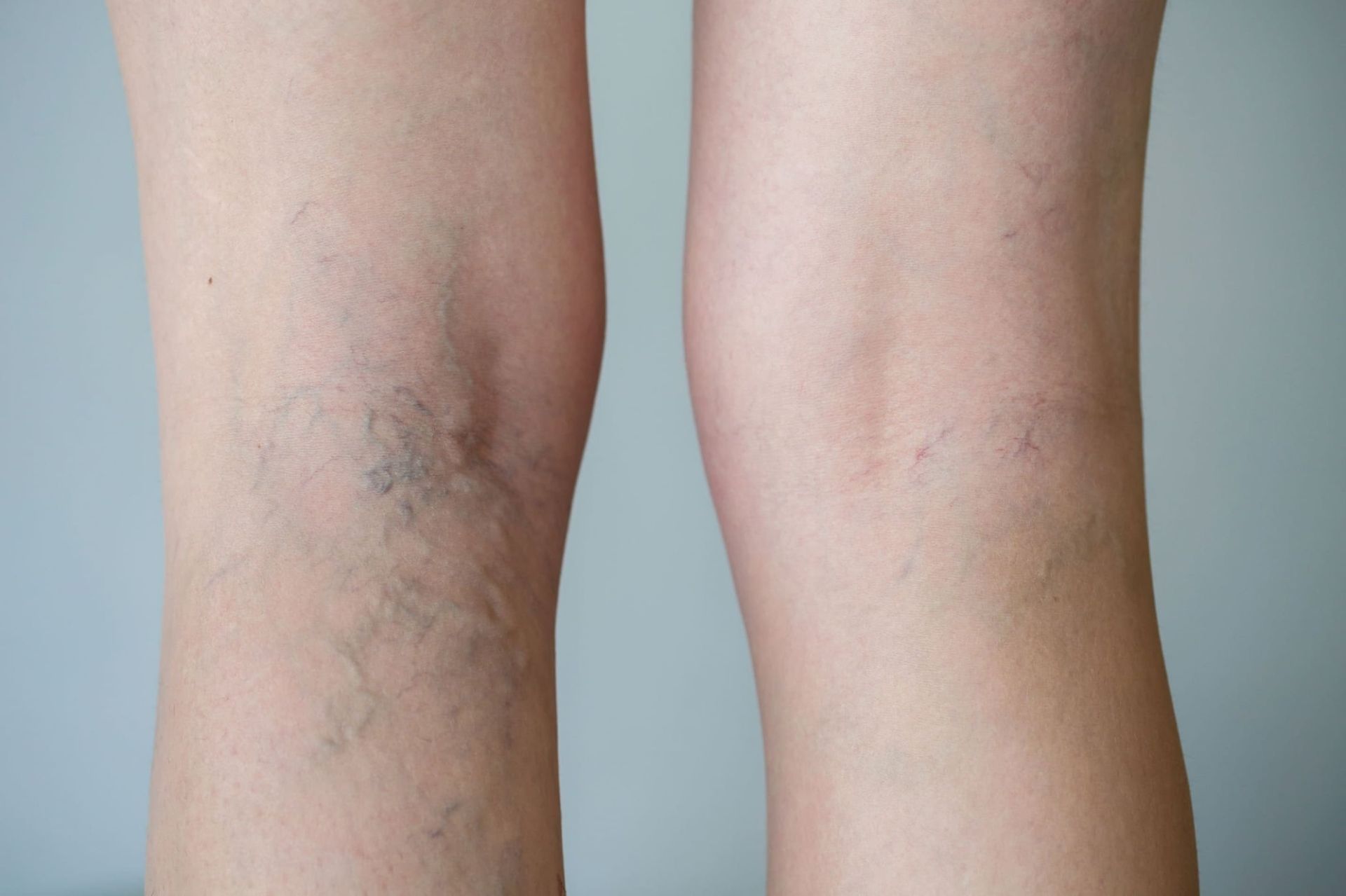 Laser Cynosure Élite Plus pour le traitement des varices