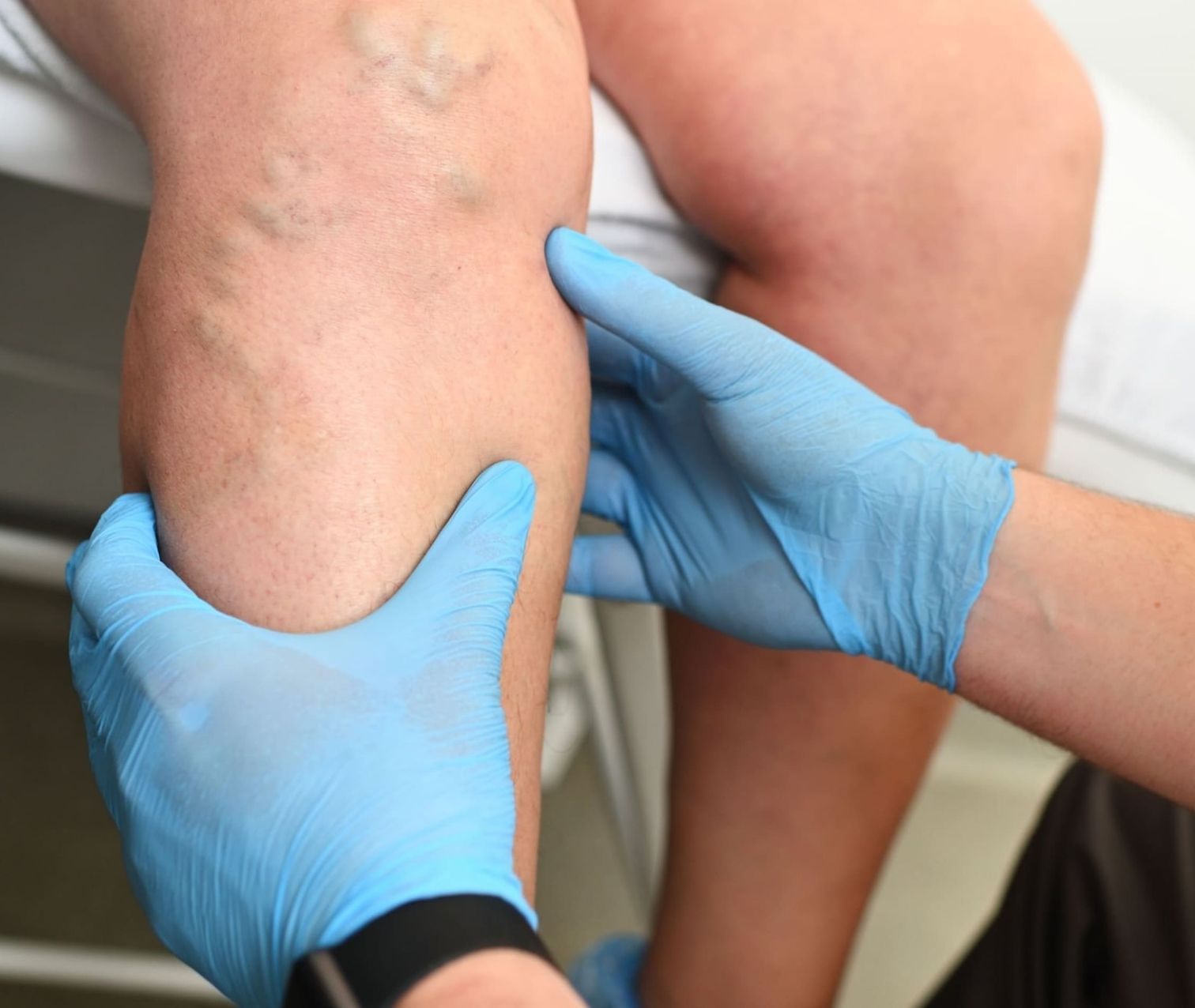 Laser Cynosure Élite Plus pour le traitement des varices