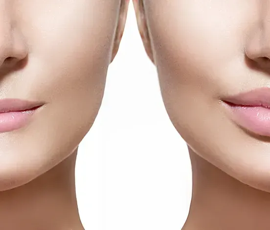 Comparison of two faces: one with thin lips, the other with fuller lips.
