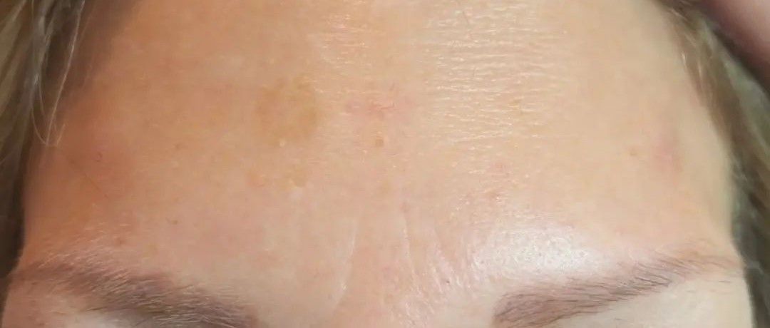 Close-up of a person's forehead, with slight discoloration and fine lines visible.