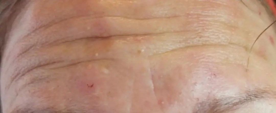 Close-up of a person's forehead, showing wrinkles and small bumps.
