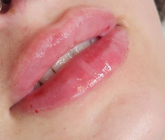 Close-up of a person's slightly parted lips, appearing plump and shiny with a pinkish hue.