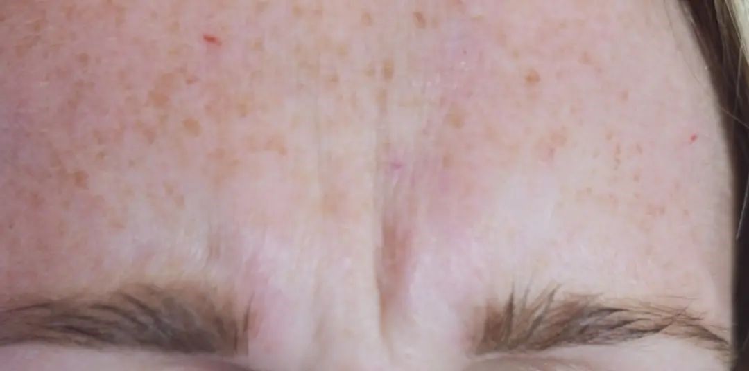 Close-up of a forehead with freckles and furrowed brow.