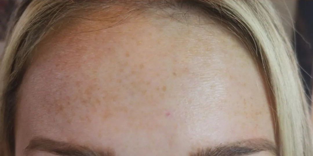 Close-up of a person's forehead with freckles, blonde hair, and eyebrow visible.