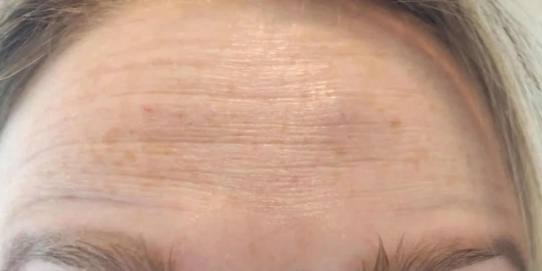 Close-up of a person's forehead, showing horizontal wrinkles and light skin.
