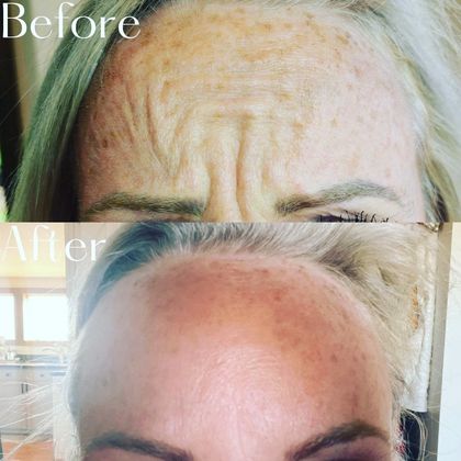Forehead with wrinkles before and after treatment, showing smoothing effect.