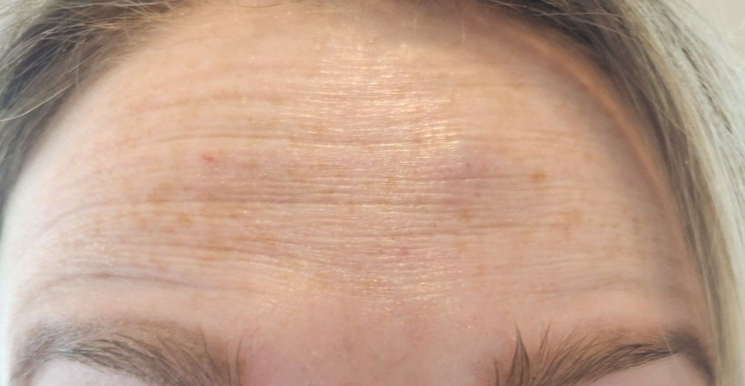Close-up of a forehead with horizontal wrinkles and a few brown spots.