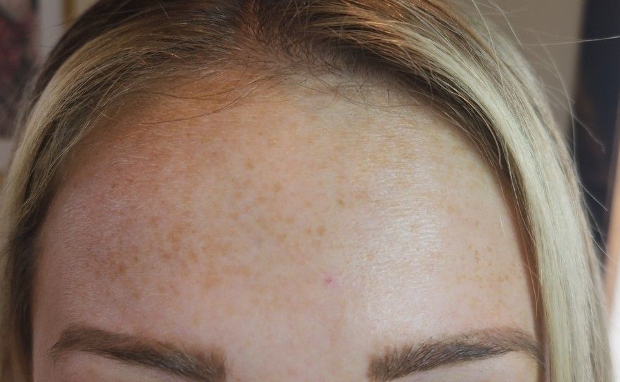 Close-up of a person's forehead with freckles and eyebrows, blonde hair frames the top.