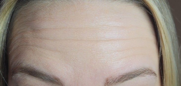 Close-up of a person's forehead with visible horizontal wrinkles, and eyebrows.