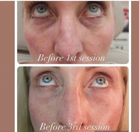 Comparison of woman's eyes before 1st and 3rd cosmetic sessions, showing reduced under-eye puffiness and discoloration.