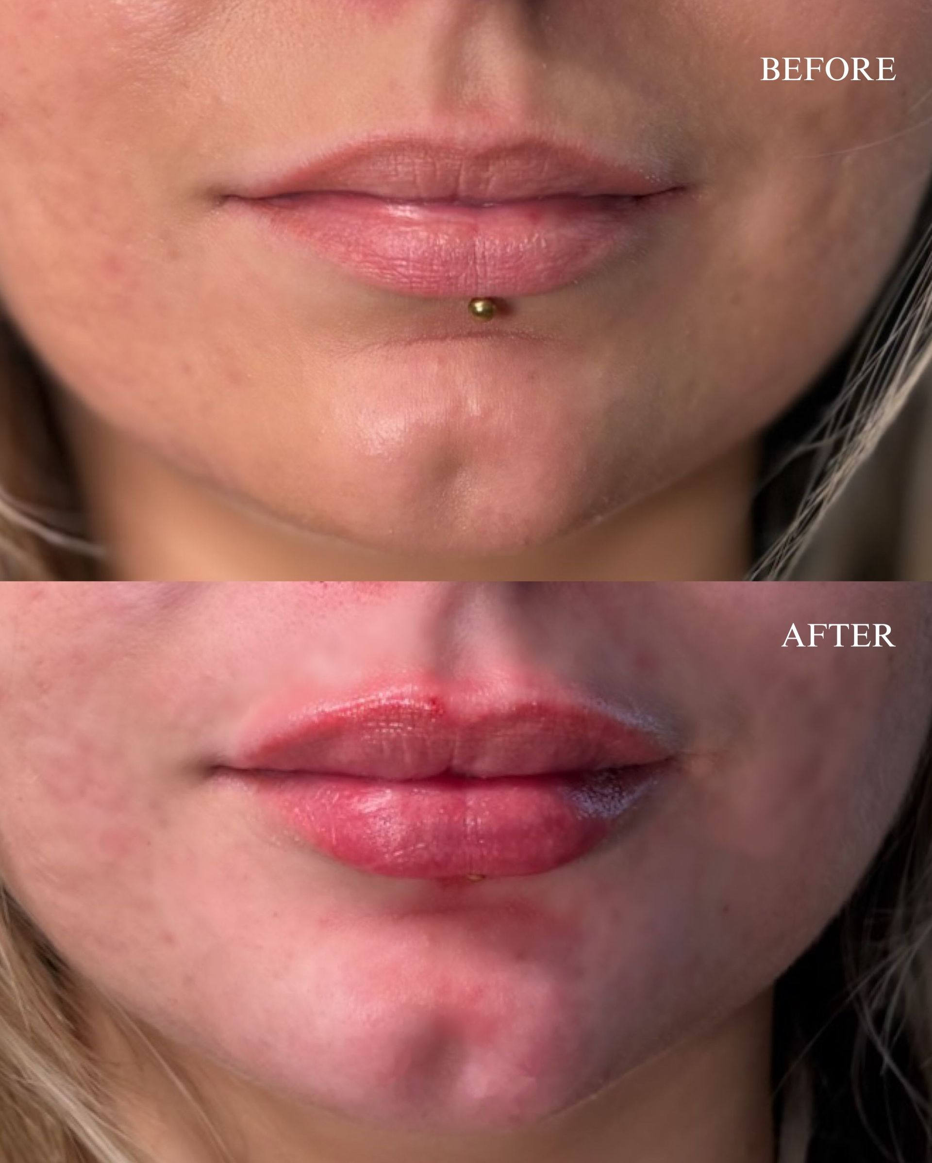 Before-and-after close-up of a lips and chin piercing, showing red irritated skin after removal.
