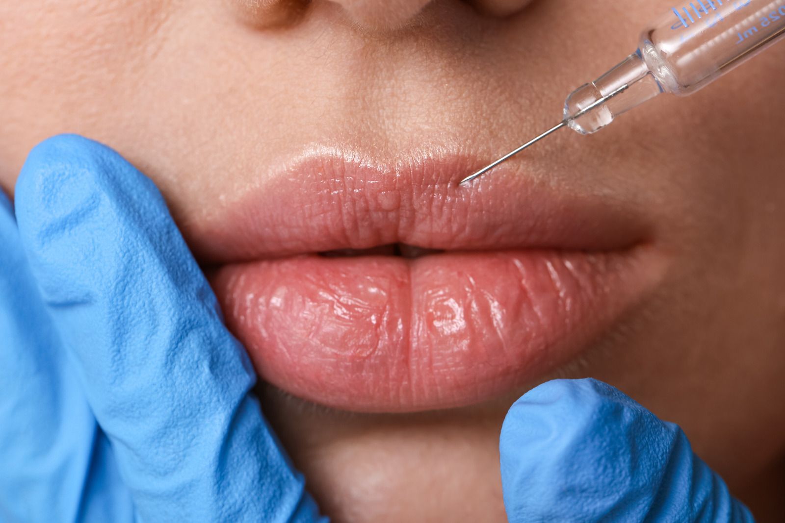 Close-up of lips being injected with filler by a gloved hand and syringe
