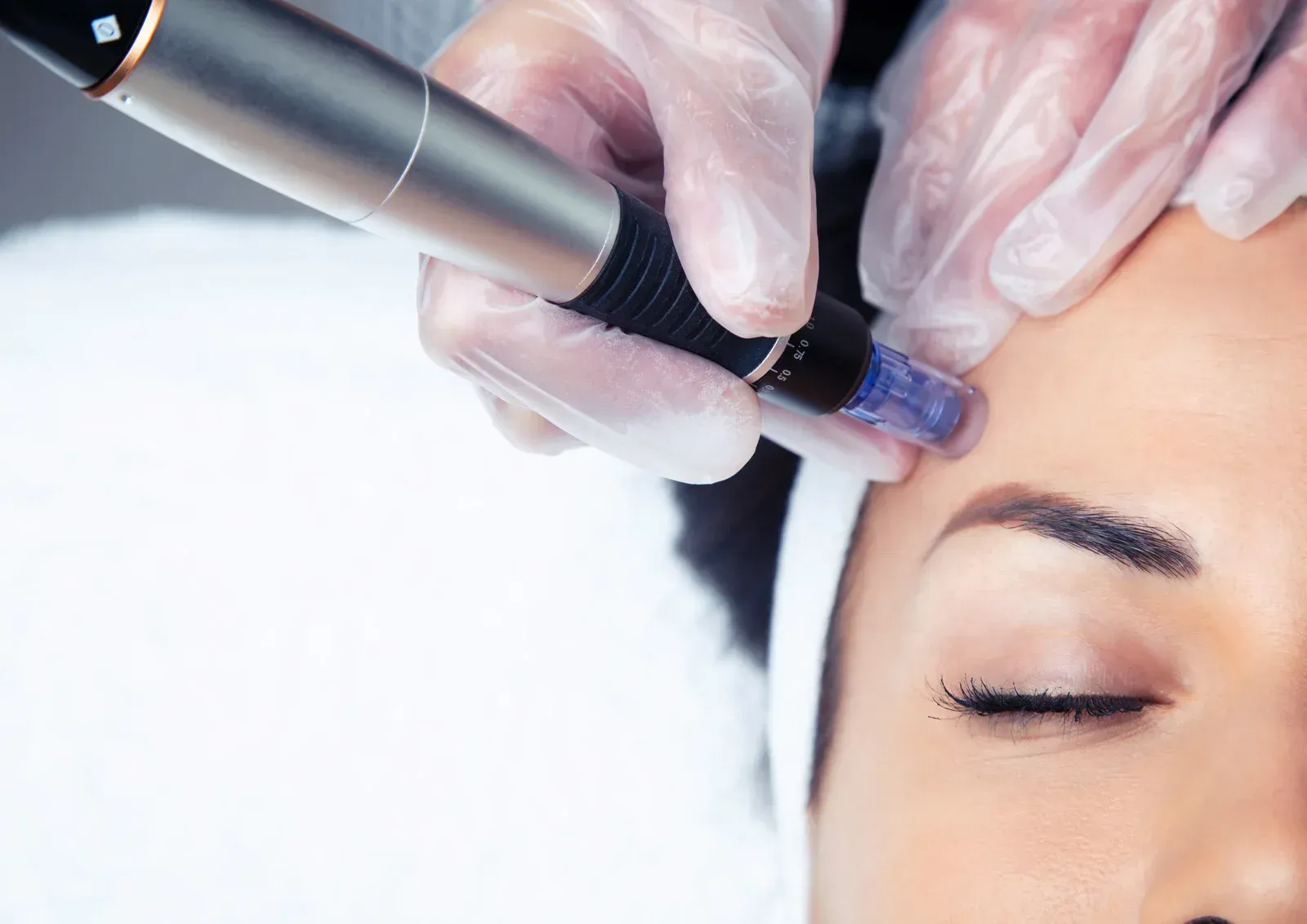 Aesthetic treatment on forehead with a microneedling pen and gloved hands