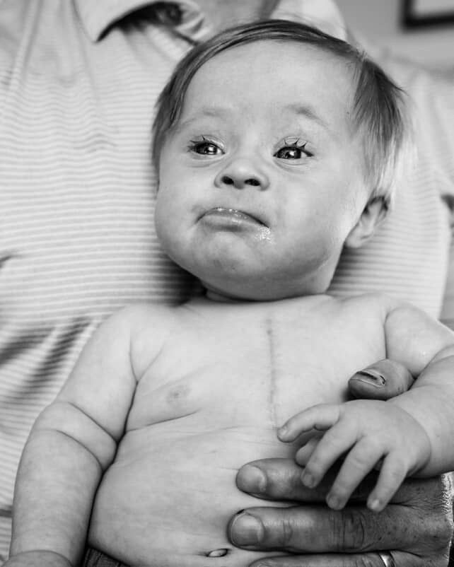 Baby with Down syndrome being held, showing scar on chest, with a concerned expression.