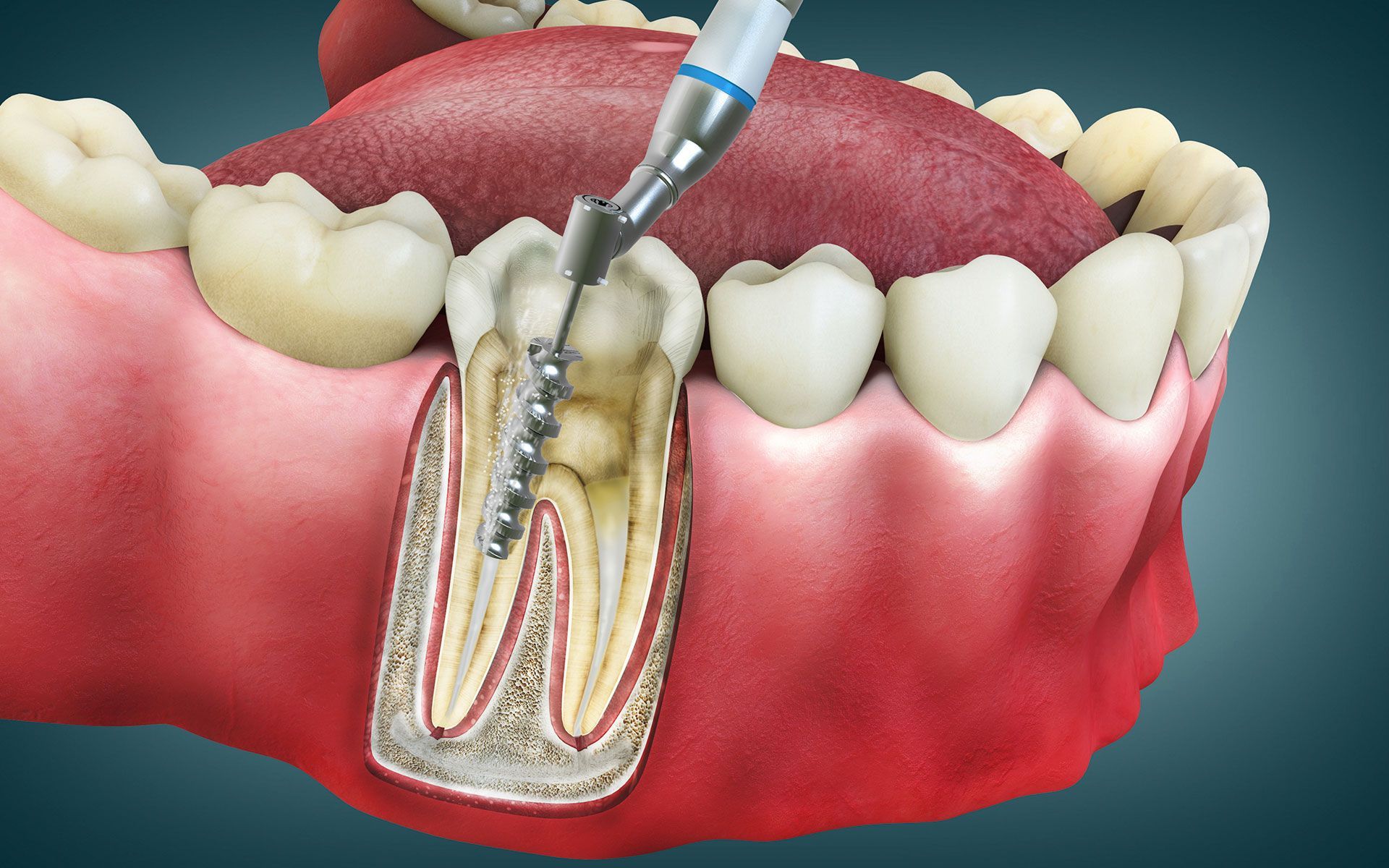 A dental drill is being used to remove a tooth.