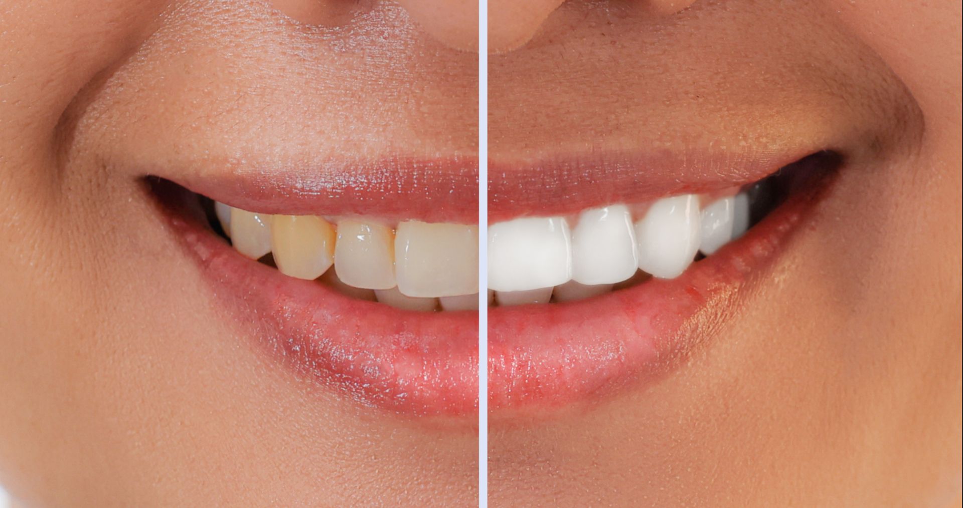 Split-screen close-up of a smiling mouth, showing natural teeth on the left and whiter teeth on the right