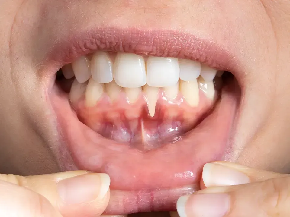 Close-up of a person's open mouth, showing teeth and gums. Fingers pull lips apart.