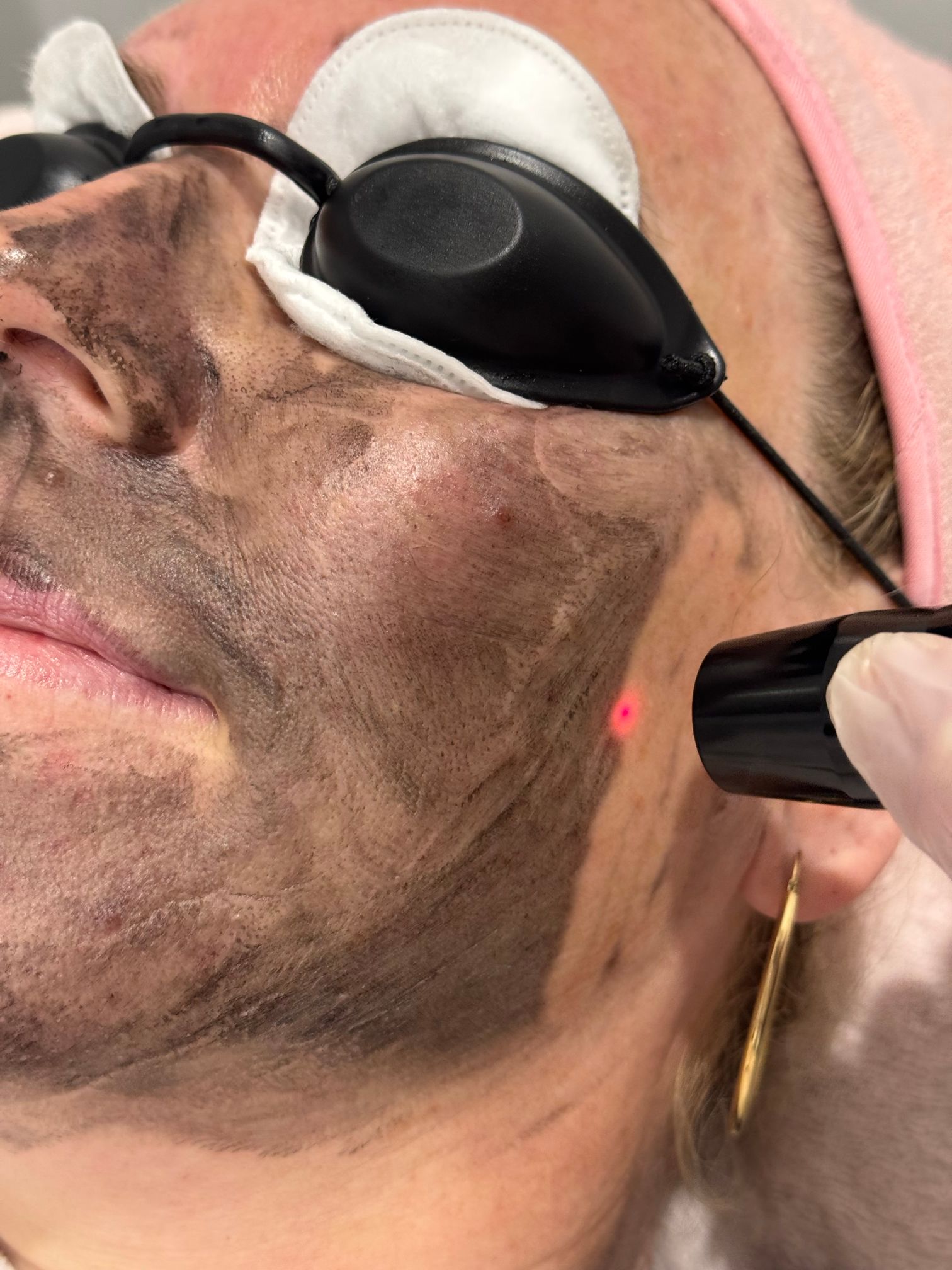 A person who had anti-wrinkle injections in Taree