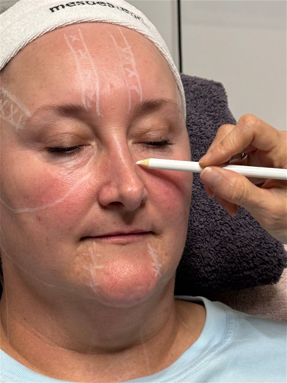 A woman is getting a laser treatment on her face.