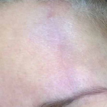 A close up of a person 's forehead with a purple spot on it.