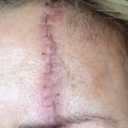 A close up of a person 's forehead with a stitch on it.