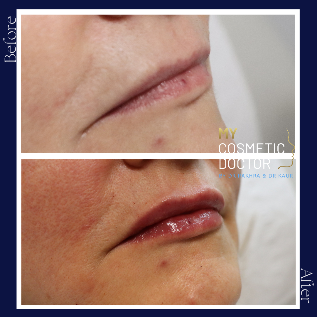 A before and after photo of a woman 's lips by my cosmetic doctor