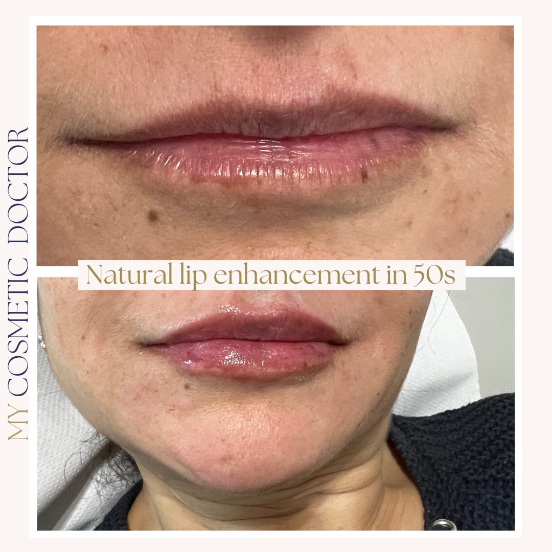 A before and after photo of a woman 's lips.