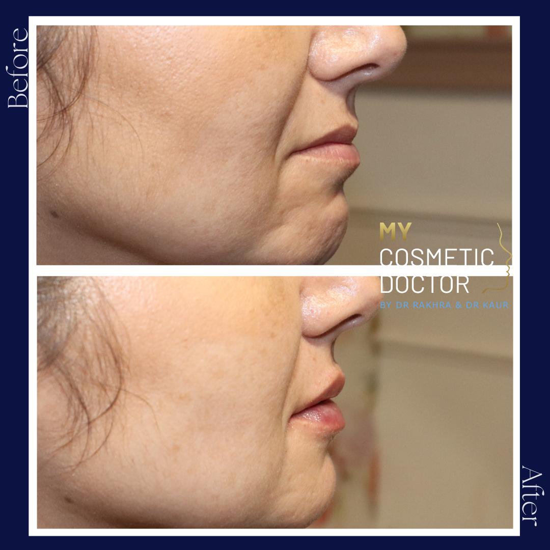 A before and after photo of a woman 's face.