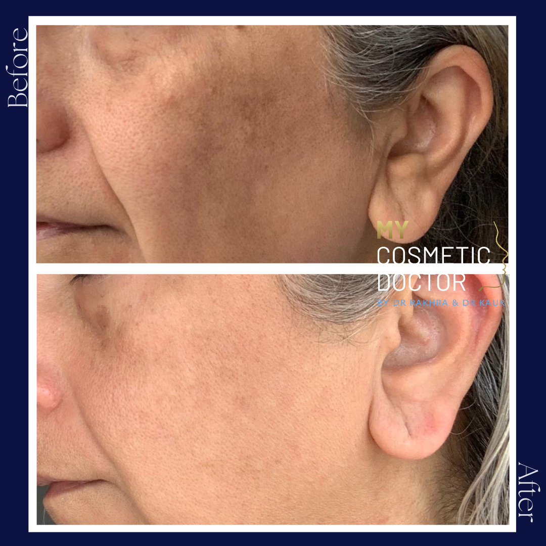 A before and after photo of a woman 's face
