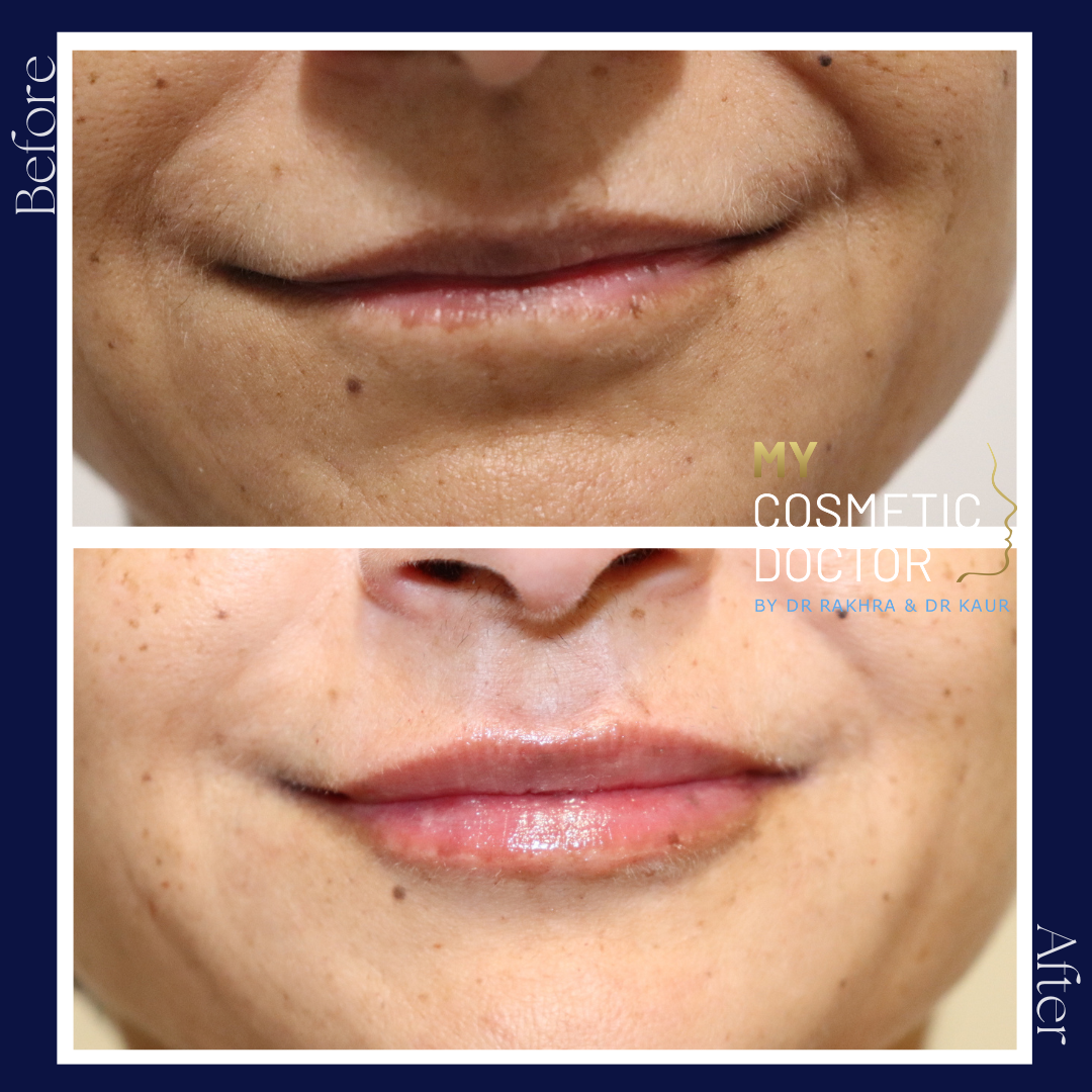 A before and after photo of a woman 's face
